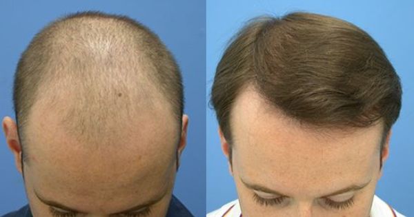 regrow hair the natural way